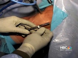 The Non-Bionic Knee Replacement
