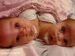 Conjoined Twins Separated