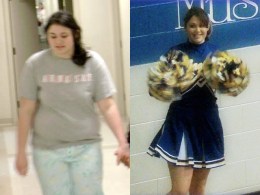 Teen Weight Loss: Going Under the Knife 