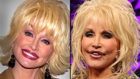 Plastic Surgery: Celebrities Then and Now