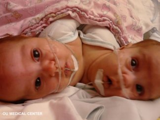 Conjoined Twins Separated
