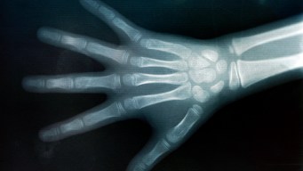 Spare Parts Make a New Hand