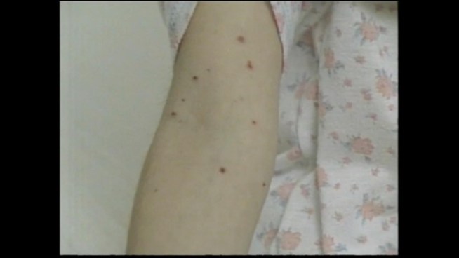 Thirty thousand people attend San Francisco State University.  Even though there are only two reported cased, chickenpox on campus so far, Dr. Alastair Smith says it's important to get the word out to student, faculty and staff.