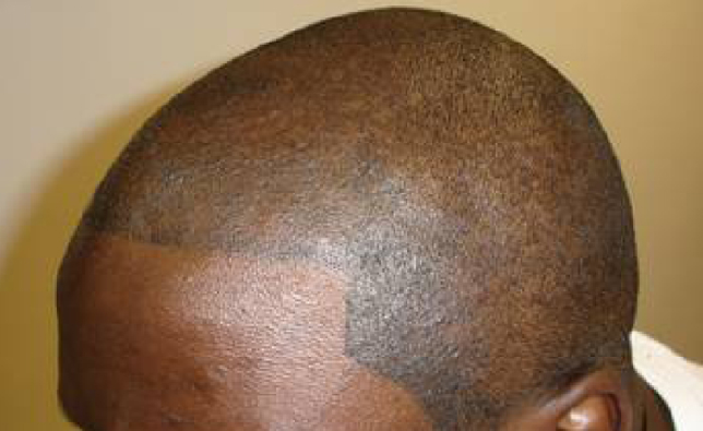 Going Bald Get Your Head Tattooed Nbc Bay Area