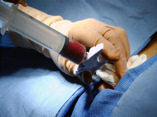 800px-Bone_marrow_biopsy