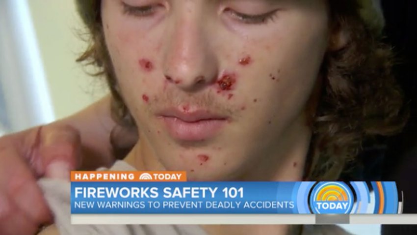 Firework Leg Injuries How to Avoid Fireworks-Related Injuries – NBC Bay Area