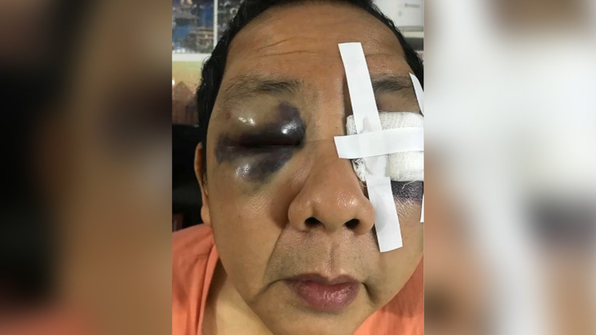 ‘I’m Traumatized’ Asian Man Attacked in San Francisco Scared to Leave