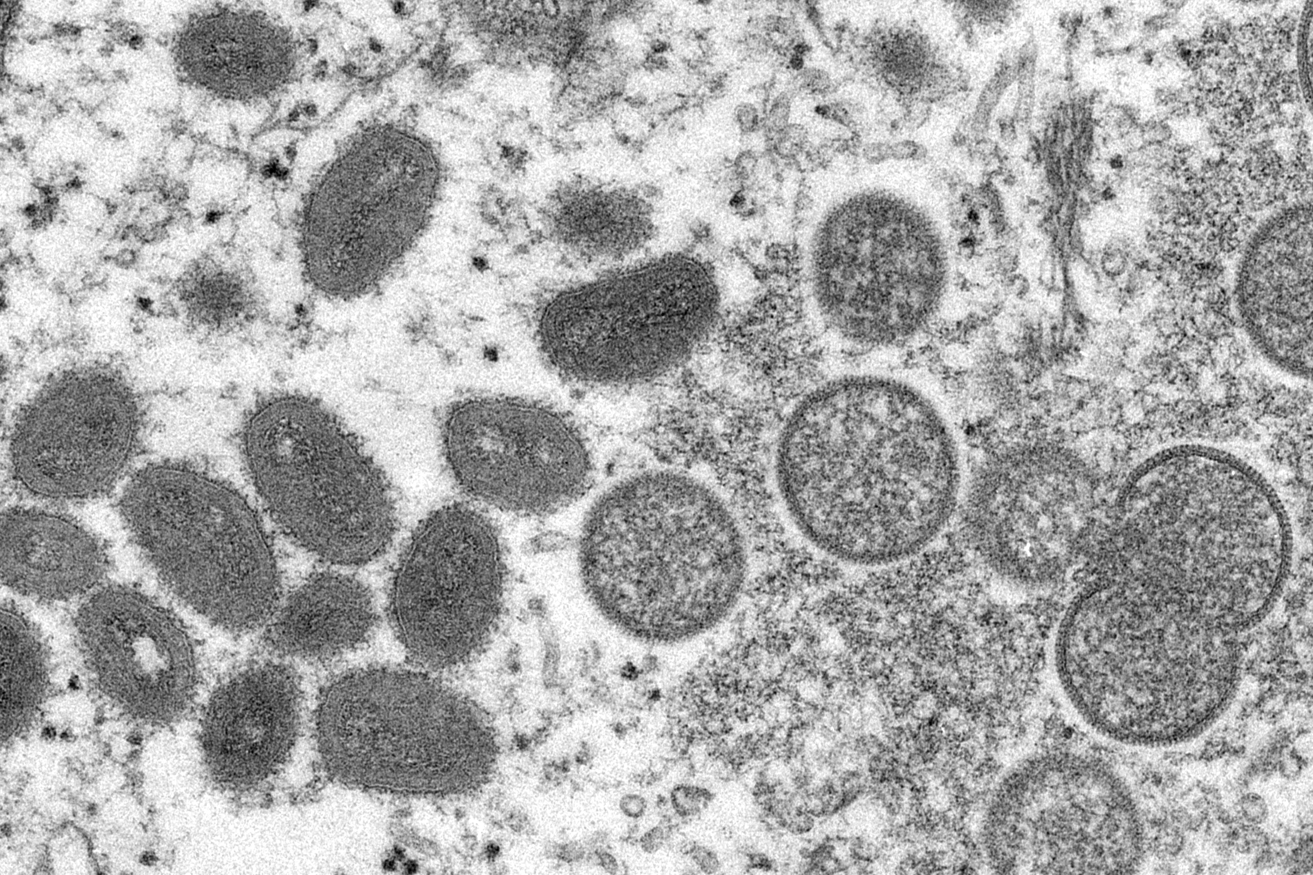 Israel Reports First Case of Monkeypox, Suspects Others – NBC Bay Area