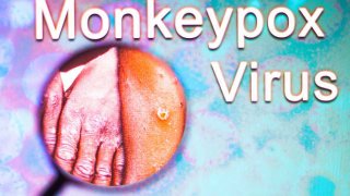 In this photo illustration, a photo of a hand infected with the Monkeypox virus is seen through a magnifying glass. Monkeypox is a viral disease that occurs mainly in central and western Africa.