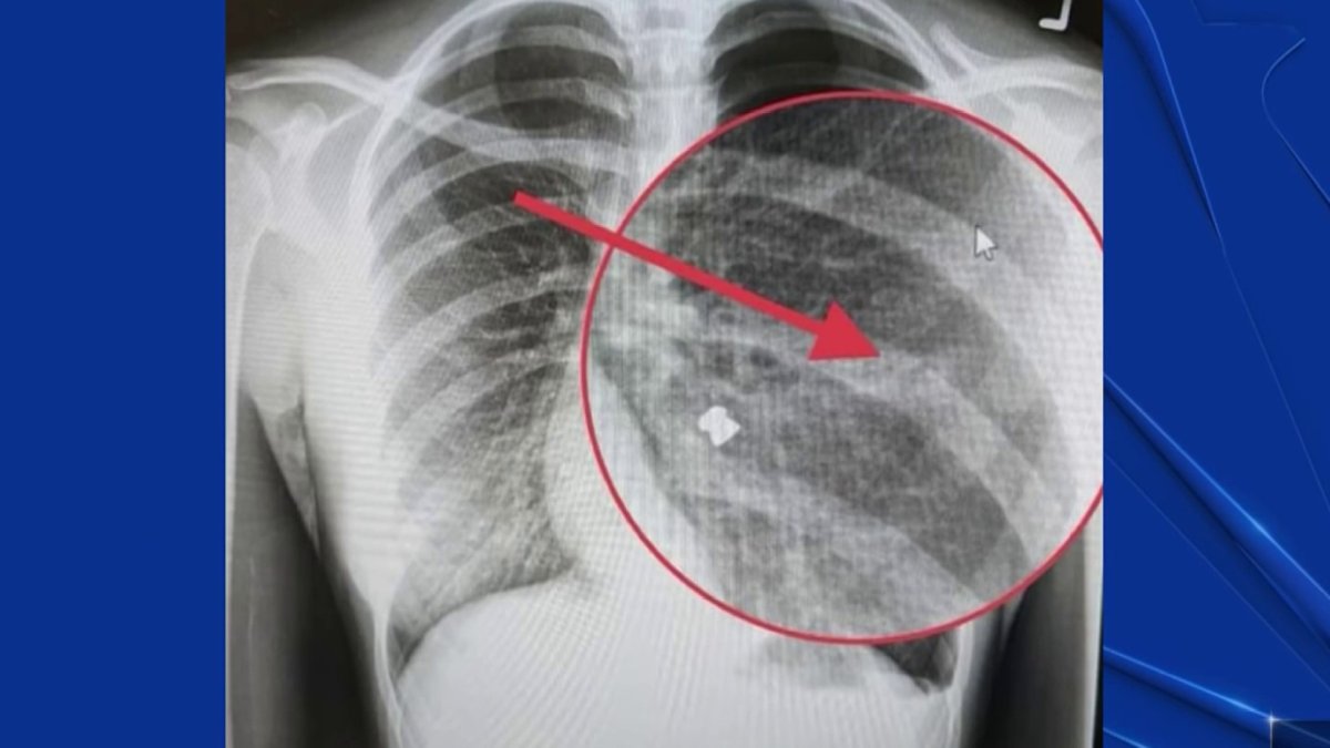 Police Investigate Pellet Gun Attacks in San Jose NBC Bay Area