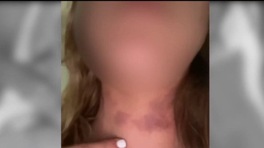 The attorney for a woman accusing former SDSU and Buffalo Bills punter Matt Araiza and his college teammates of gang rape released photos of the accuser alleging to show injuries sustained in the gang rape.