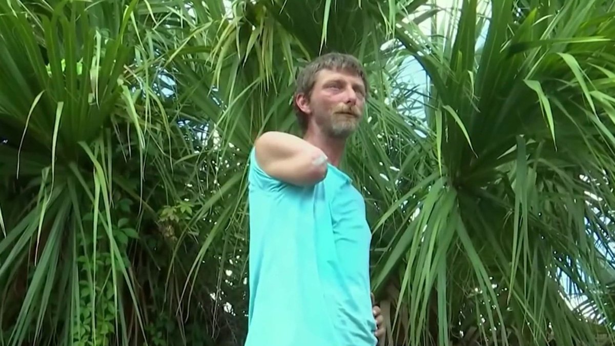 Man Shares Survival Story After Losing Arm in Alligator Attack Near Tampa – NBC Bay Area - Vimarsana News