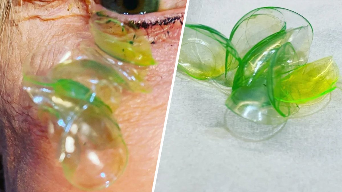Woman Had 23 Contact Lenses Stuck Under Her Eyelid, Doctor Says – NBC Bay Area - Vimarsana News