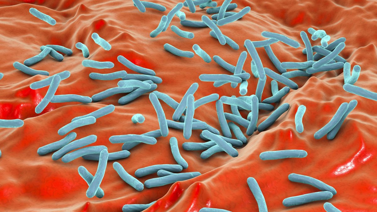 Het aantal gevallen van tuberculose in Santa Clara County neemt toe – NBC Bay Area