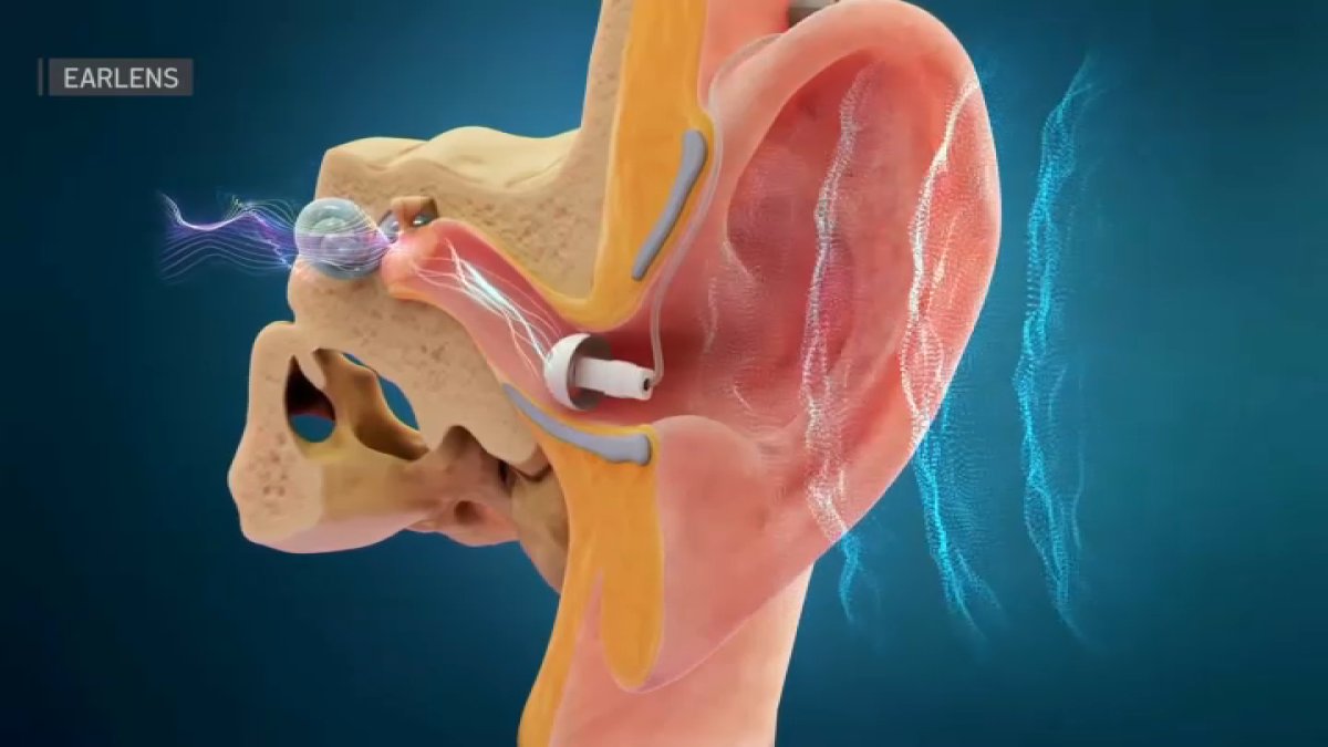 Doctors call hearing aid developed in Menlo Park a 'game-changer' – NBC Bay Area - Vimarsana News