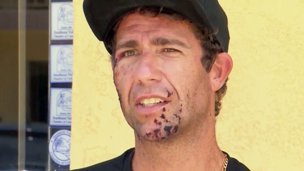 Surfer recalls getting bit in the face by shark at Florida beach – NBC Bay Area - Vimarsana News