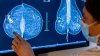 Why some doctors see a downside to notifying women about dense breasts