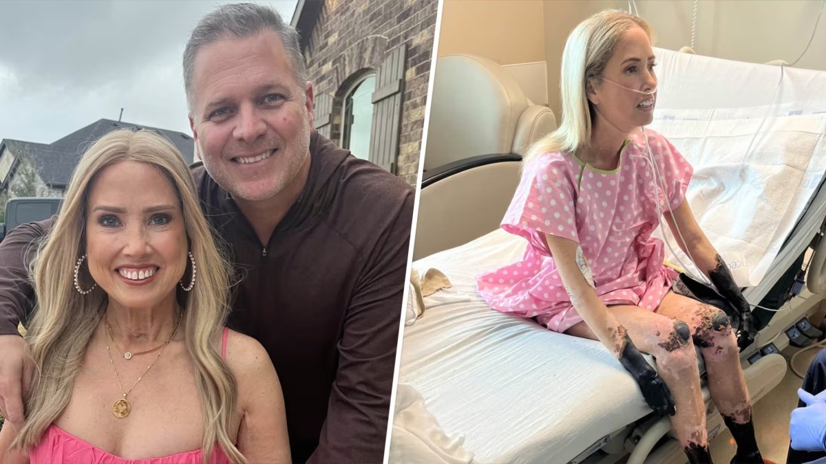 Woman’s strep infection leads to sepsis, ‘mummified’ hands and feet