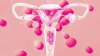 PCOS symptoms are still difficult for doctors to diagnose and treat. Here's why