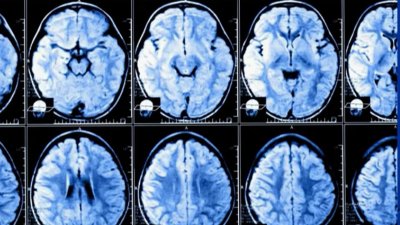 UC Davis finds brain sizes are growing