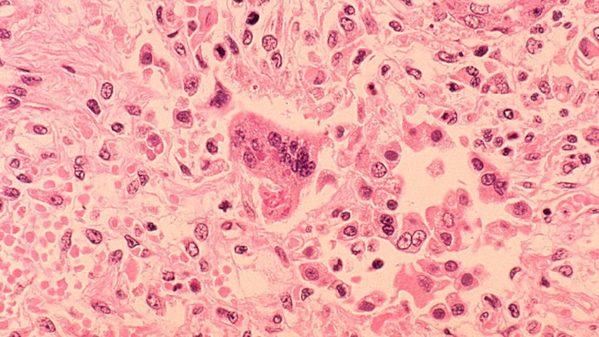 First measles case in Napa County since 2012