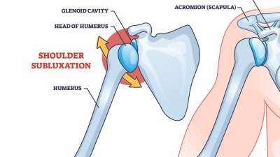 What is a shoulder subluxation?