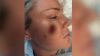 Routine skin check turns to nightmare as woman leaves with gaping hole in her face