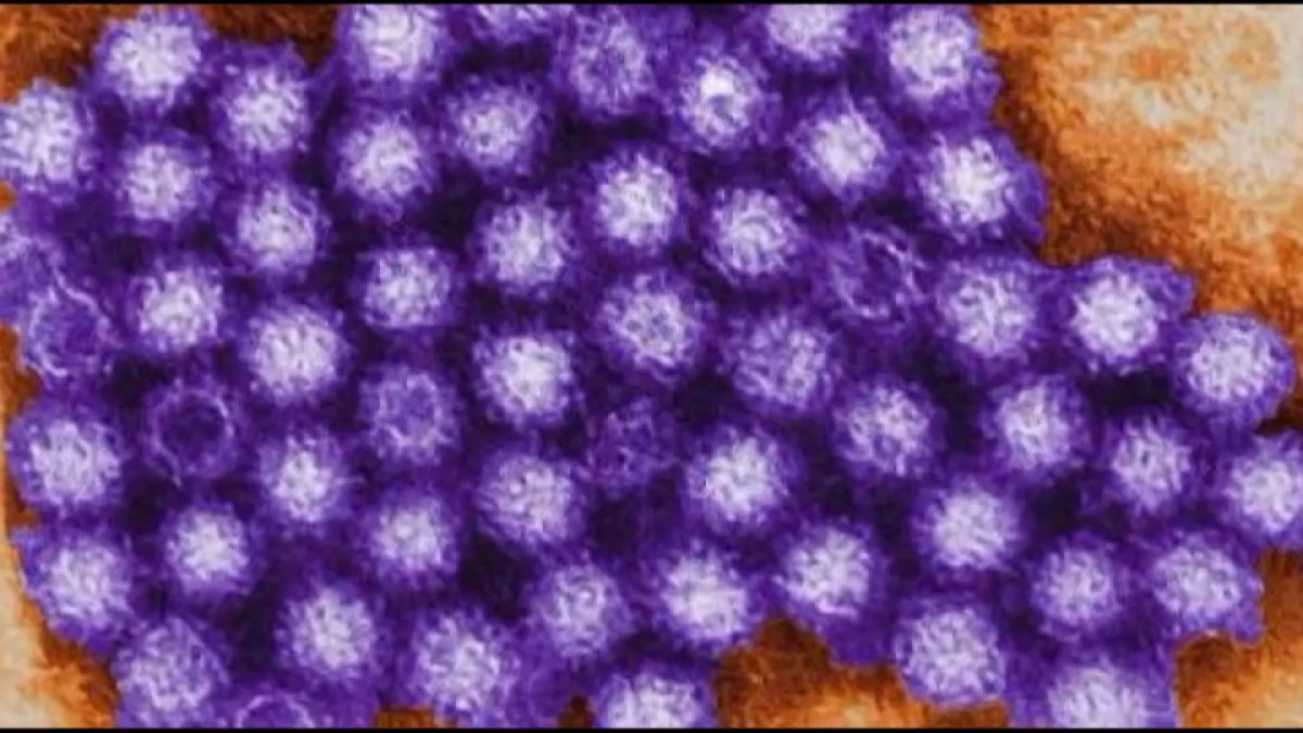 What to know about a spike in norovirus cases