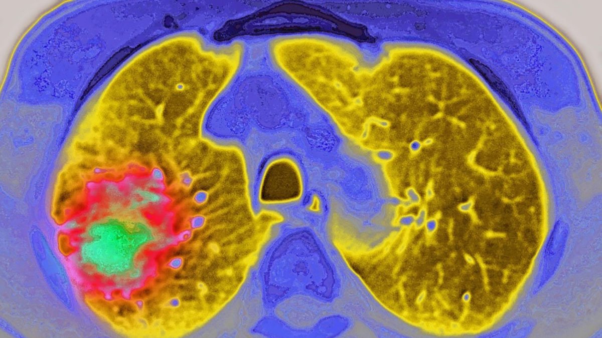 GLP-1 drugs may reduce risk of cancer progressing, study suggests – NBC ...