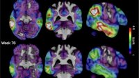 High levels of tau protein, in red, dropped in a recipient of the company's experimental Alzheimer's drug diranersen...